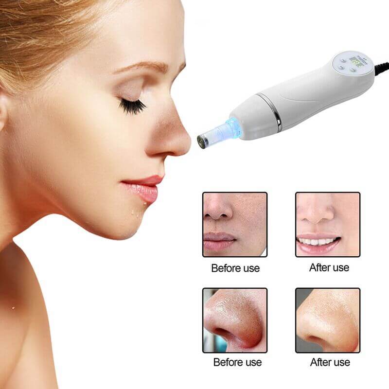 Blackhead Remover